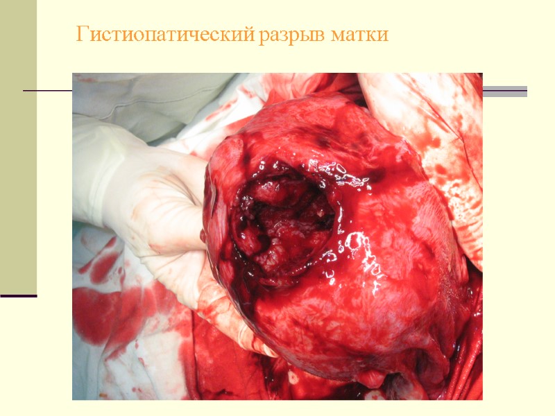 Гистиопатический разрыв матки